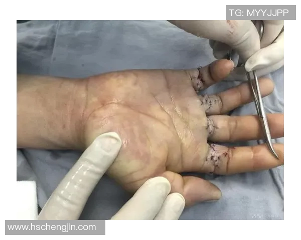 森林狼新星训练中遭遇挫折右手小指受伤需观察两周恢复情况